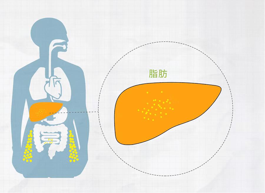 脂肪肝要注意什么应该吃什么食物,脂肪肝吃什么好得快最有效