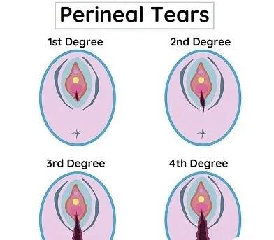 如何防止顺产的撕裂和侧切,怎么预防顺产撕裂疼