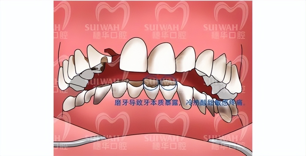 磨牙时间长了牙会变成什么样,磨牙牙齿变黑是怎么回事
