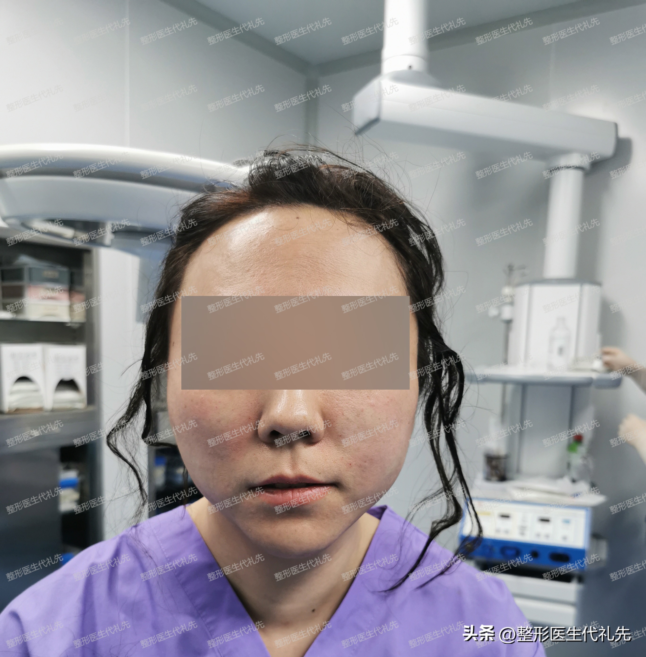 30岁脸部提升紧致最好的手术,最新脸部祛皱提升手术