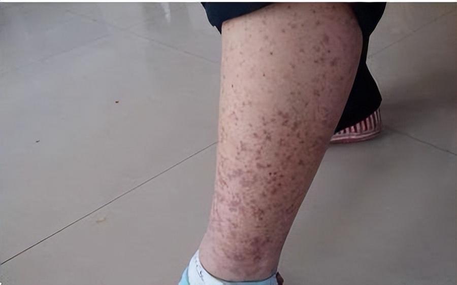 紫癜最忌口食物一览表,紫癜初期小血点图片