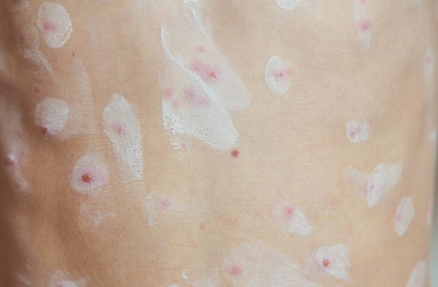 40岁出水痘要注意哪些,40多岁的人会不会得水痘