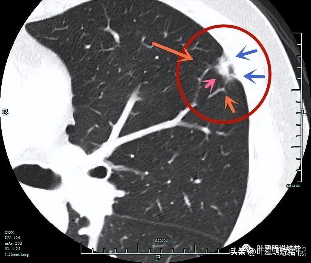 有关肺部结节的知识,医生判定存在风险的肺结节