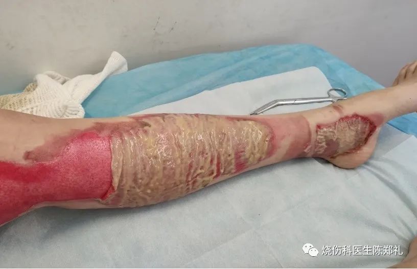 慢性创面患者的敷料运用及选择,创面换药敷料的选择