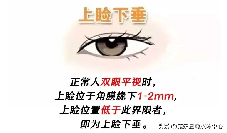 做双眼皮手术过程要睁眼睛吗,做了双眼皮后眼睛睁不大是咋回事