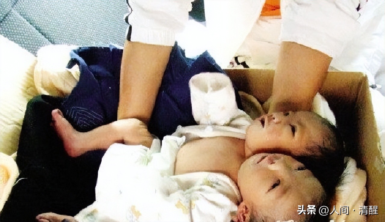 女孩去做体检发现怀了四胞胎,女子怀双胞胎竟是被遗传