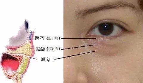 自己怎么修复泪沟,泪沟是消除不了的吗