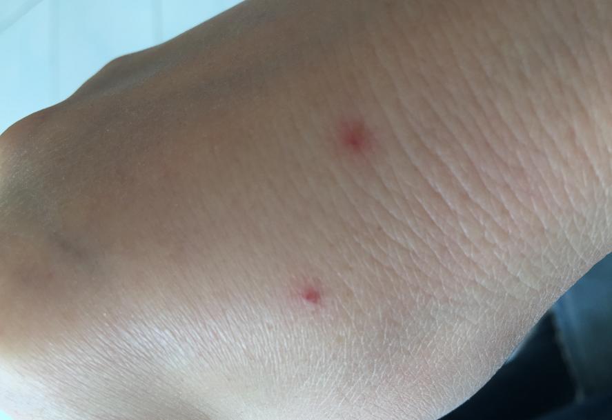 有红点很可能是肝病恶化了,出现这些红点可能是肝硬化