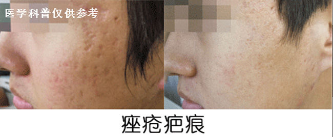 plasma和点阵激光祛痘坑哪个好,点阵激光仪去痘坑前后对比