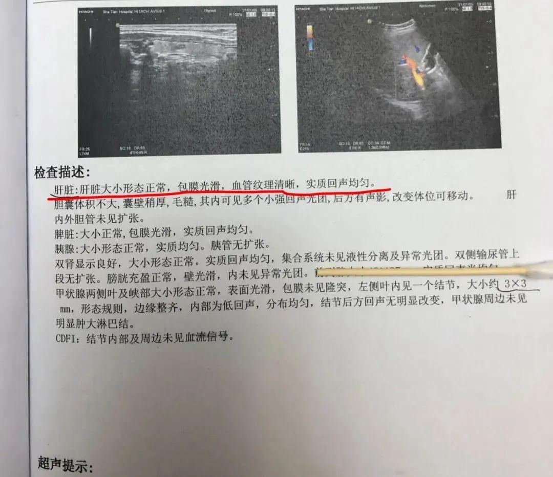 肝囊肿中医可以治好吗,肝囊肿可采用消融手术吗