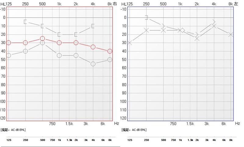 中耳炎耳膜大穿孔手术修补成功率,中耳炎穿孔手术微创