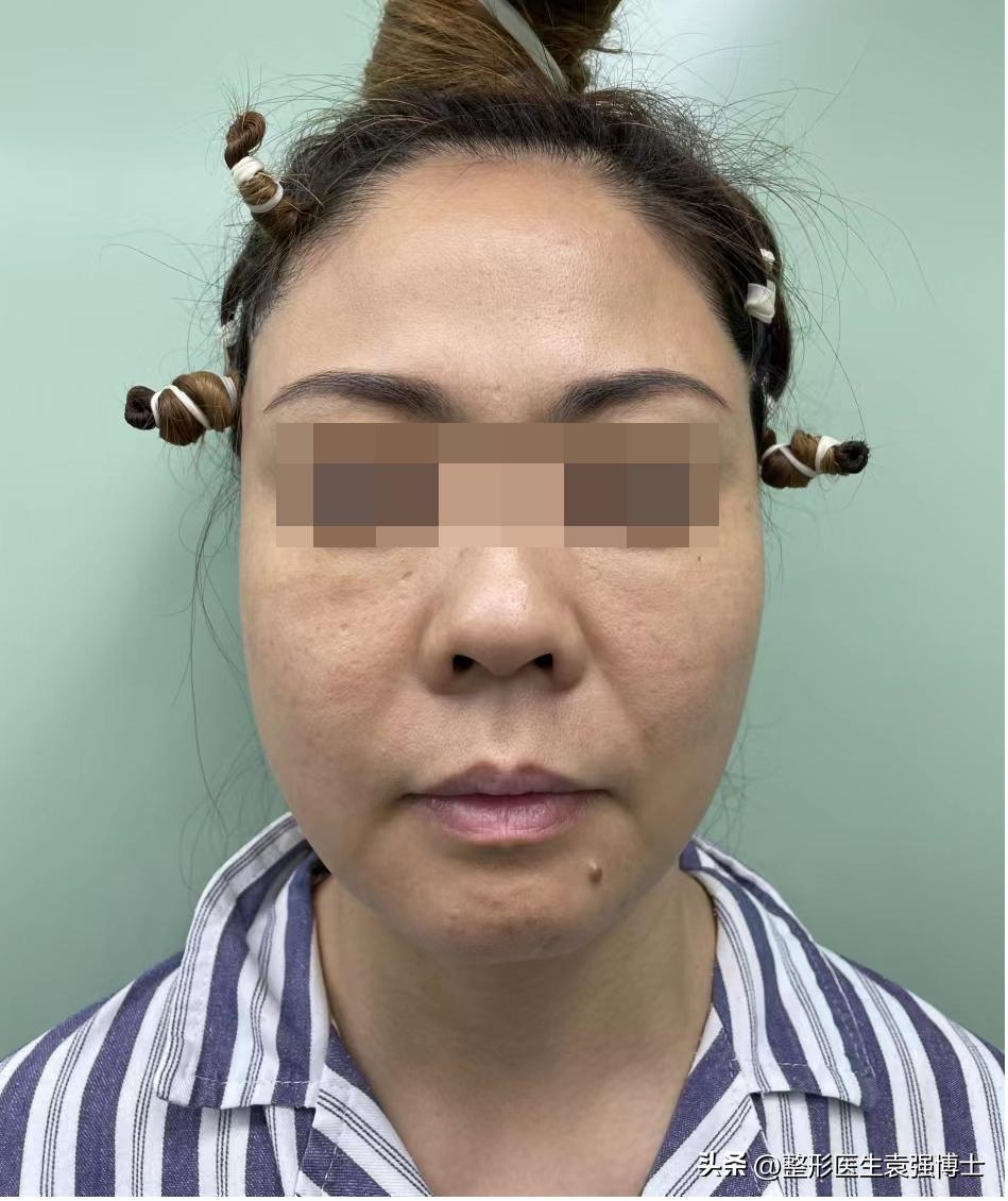 46岁肌肤松弛能做拉皮手术吗,46岁脸部下垂还能做拉皮手术吗