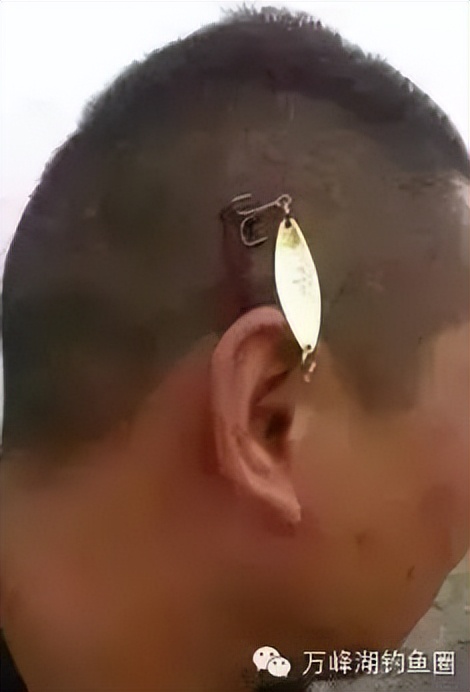 技巧：钓鱼引发流血事件，倒刺钩挂手处理办法