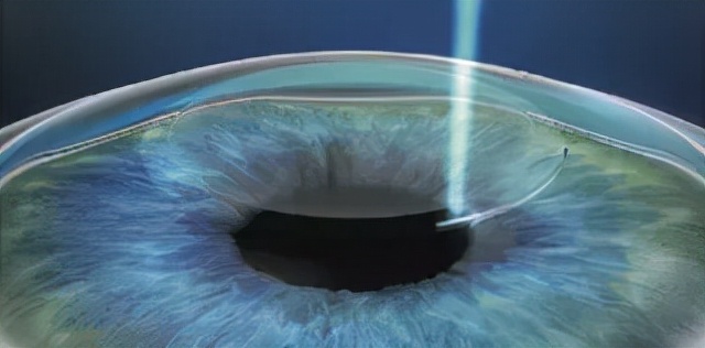 王凯医生工作室丨全飞秒SMILE手术全攻略