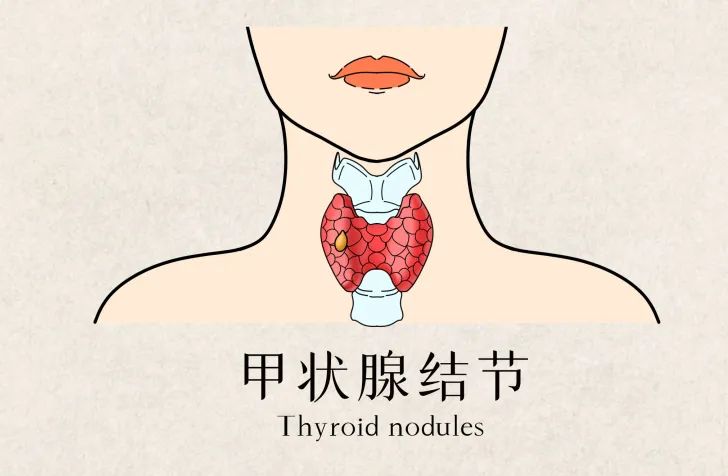 甲状腺结节与甲亢甲减有什么关系,甲亢甲减结节哪个严重