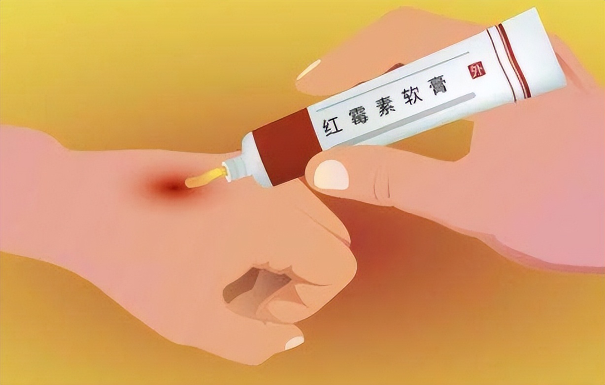 红霉素软膏涂眼睛后果,红霉素软膏眼白处可以涂吗