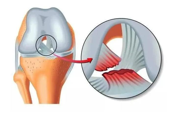 膝关节韧带损伤有哪些症状,韧带损伤的症状和治疗方法