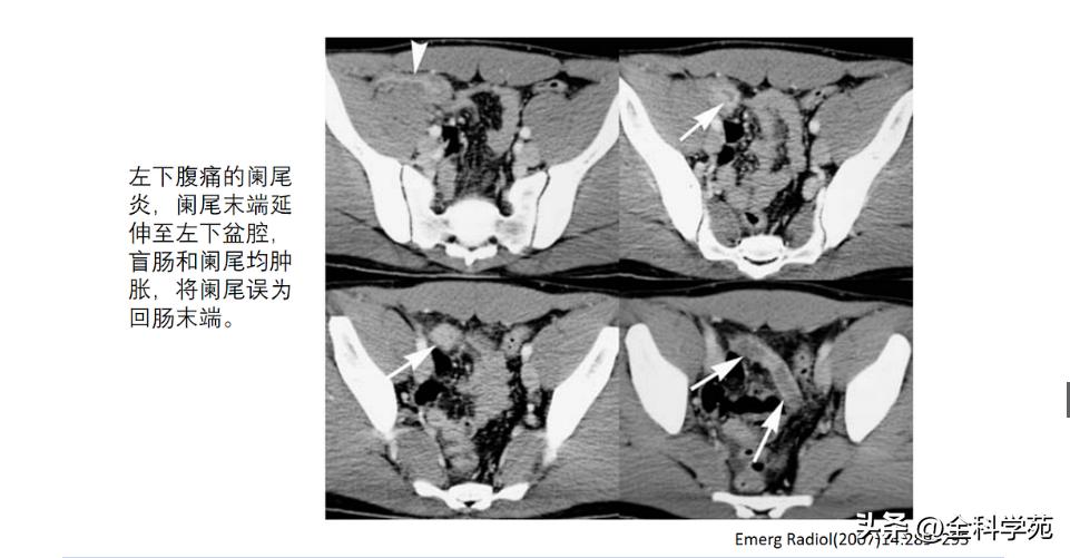 阑尾炎的讲解,关于阑尾炎的讨论总结