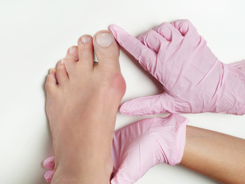 大脚趾长歪了指甲也歪,大脚趾拇囊炎是怎么引起的