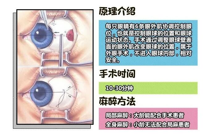 孩子斜视手术后还是斜视,斜视弱视可以做斜视手术吗