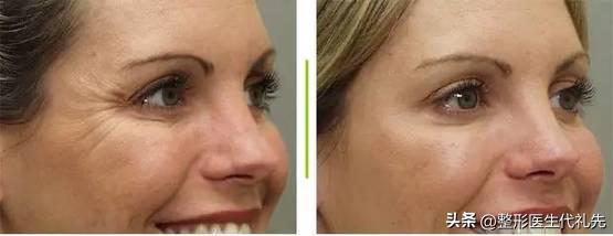 医生打肉毒素的猫腻,医生打肉毒素稀释药液的原因