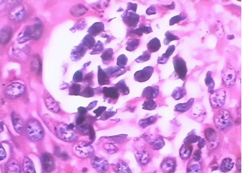 阴道炎到宫颈炎的演变及诊治策略