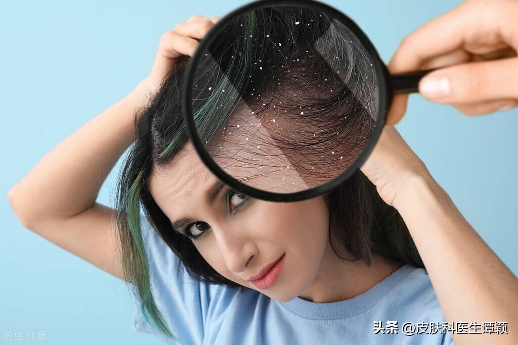 脂溢性皮炎头皮屑特别大怎么办,头皮屑多是脂溢性皮炎怎么解决