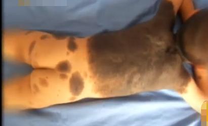 河北女子割皮救父,河北行唐母亲割皮救儿子