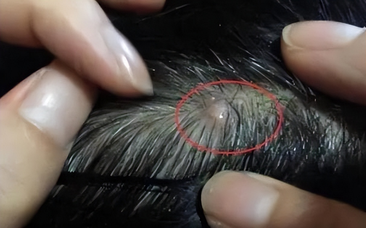 男士头上长疙瘩脓包,头上起疙瘩有脓包还掉发什么原因