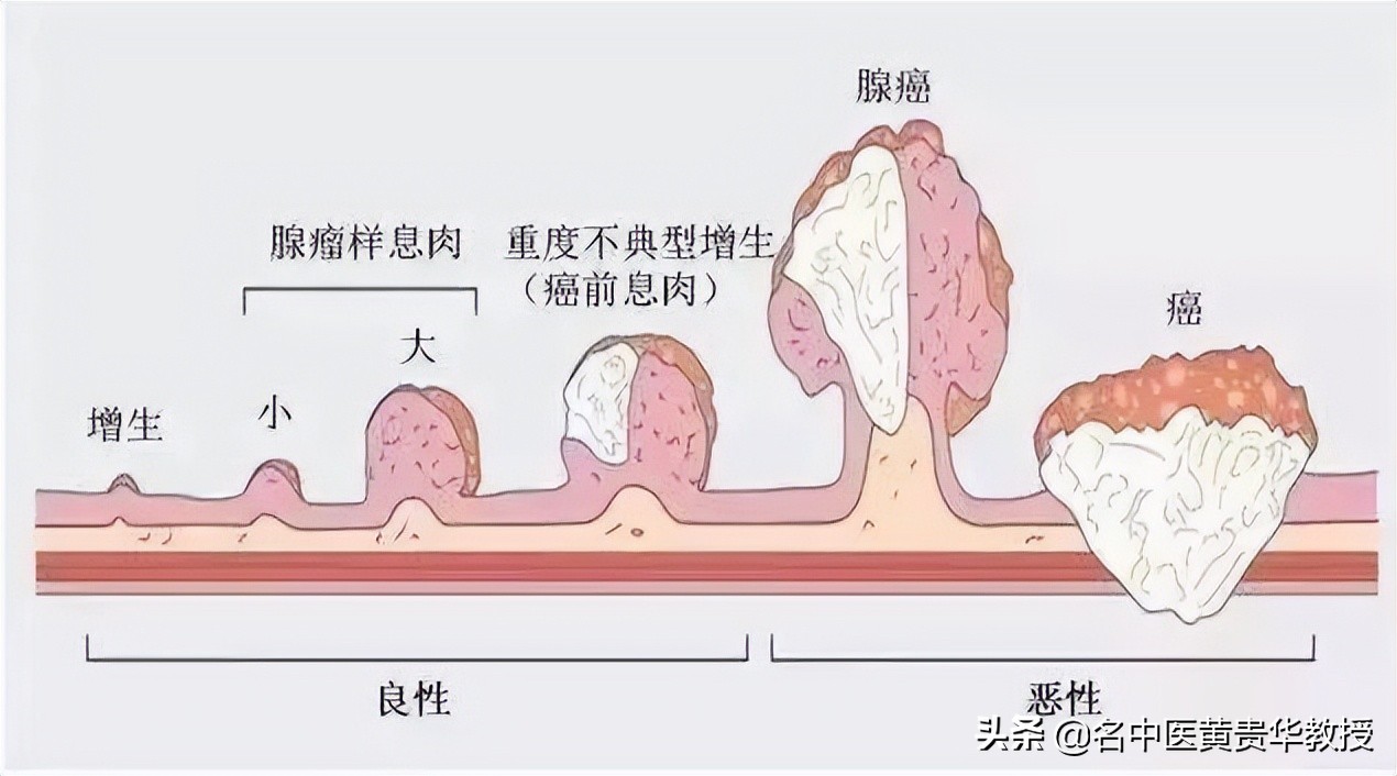 管状腺瘤29岁,1.5厘米管状腺瘤切除后癌变吗