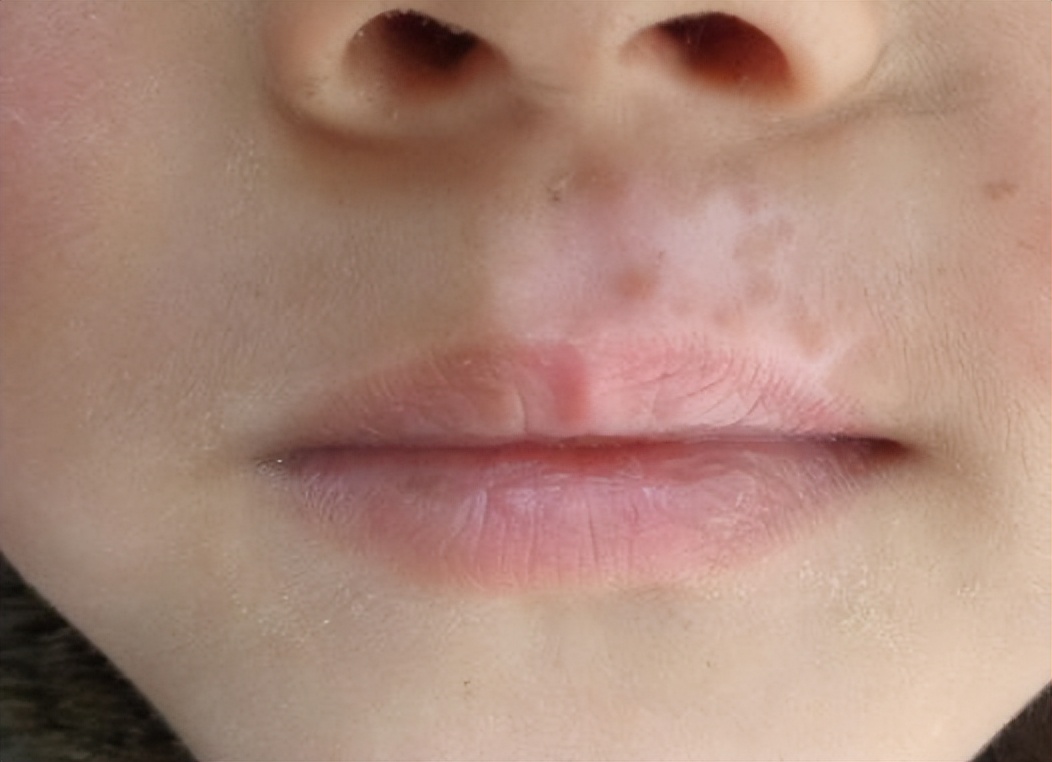 白癜风用药最多的是什么药,选择治疗白癜风方法谨记三大事项