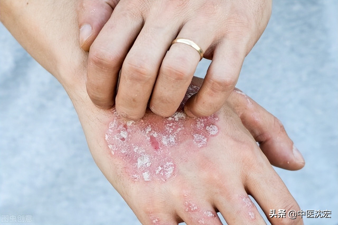 湿疹反反复复用什么中药治疗最好,肛周湿疹中医怎么辨证