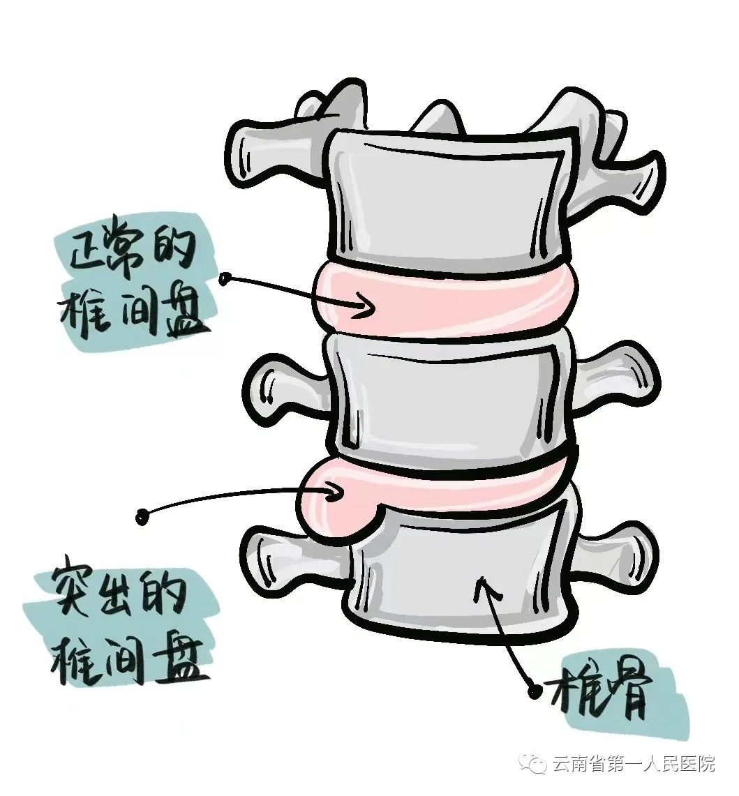 一招教你远离腰椎间盘突出,年纪轻轻就得了腰椎间盘突出