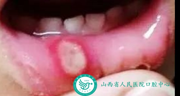 口腔溃疡反反复复咋办,口腔溃疡反反复复发热