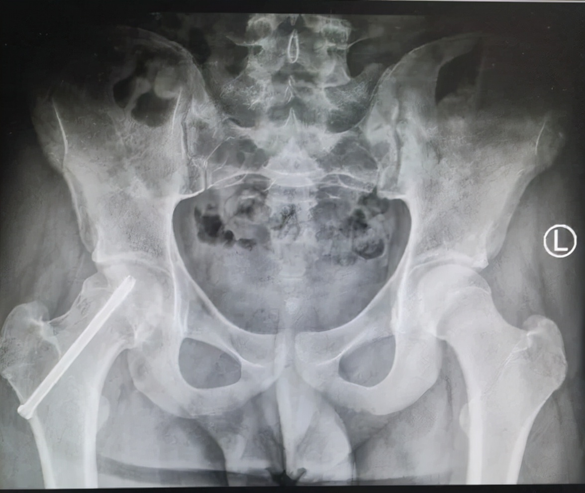 小儿骨科科普类短视频,股骨头骨骺滑脱中医手法治疗