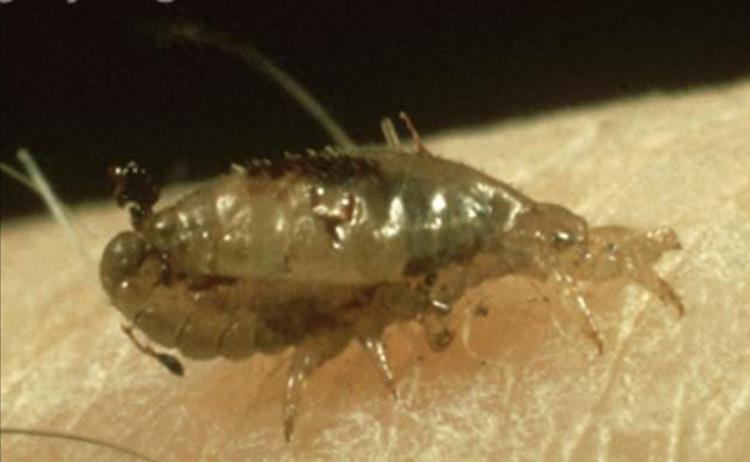 女子身上长虫医生拿镊子治疗,女子体内有蜱虫被医生拿镊子拔出