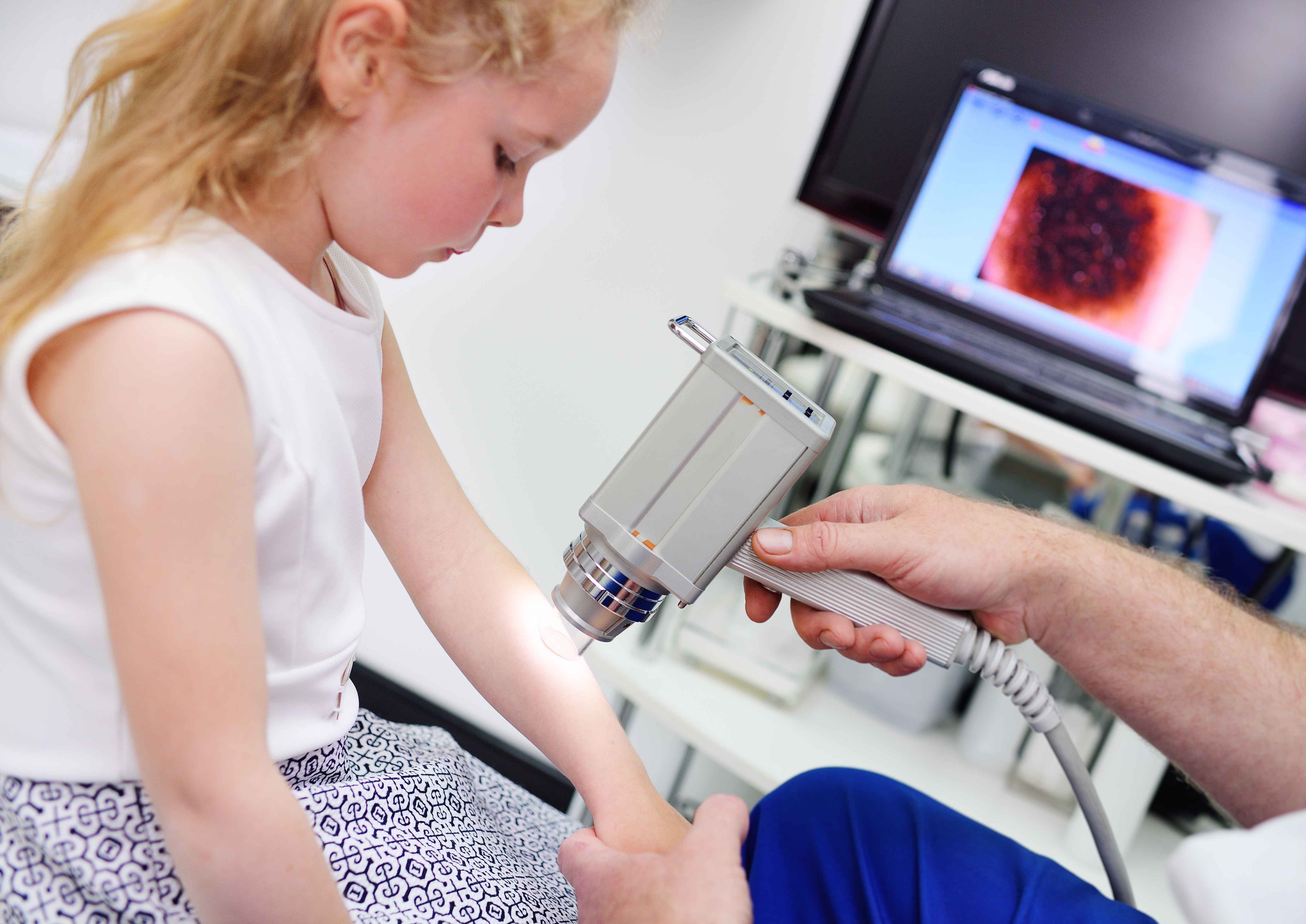 血管瘤和血管痣如何鉴别,血痣是血管瘤引起的吗