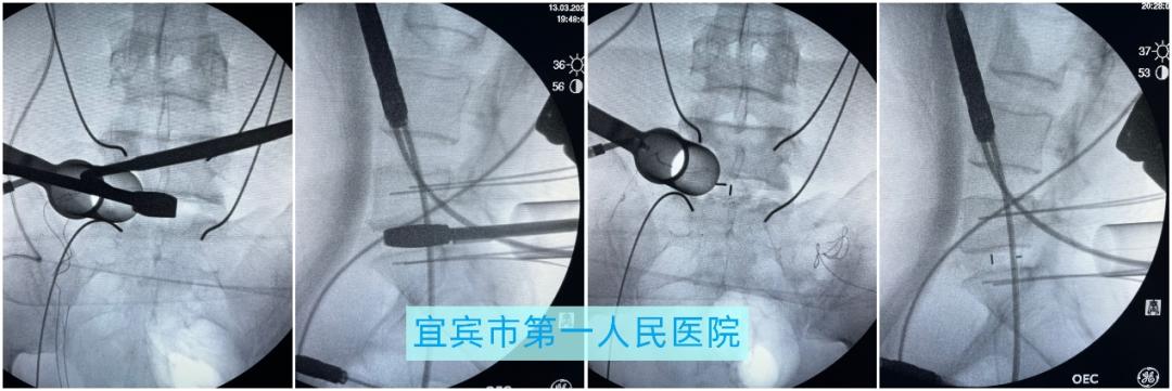 腰椎康复在家自我疗法,腰椎微创康复
