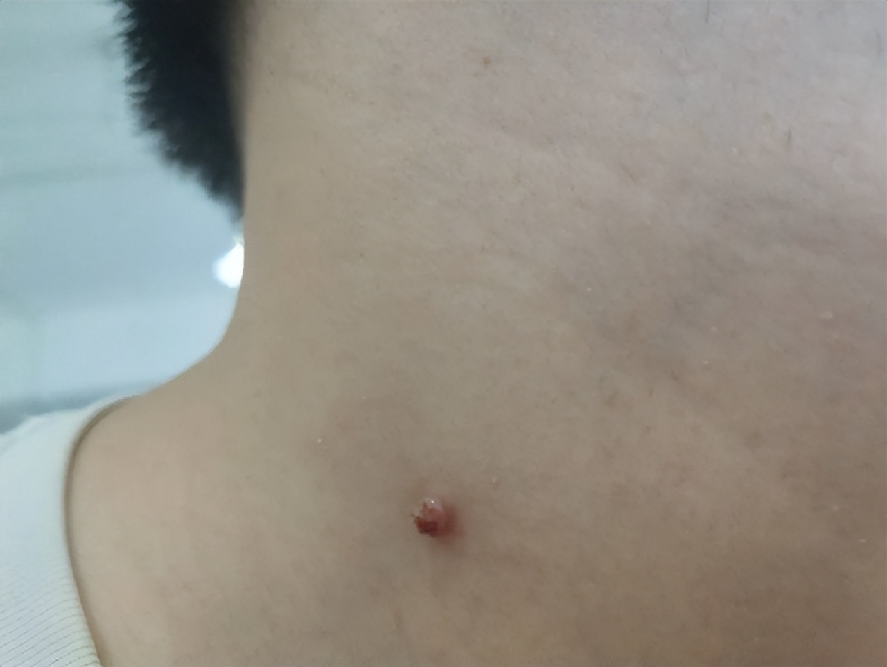 脖子上长的小肉粒可以揪掉吗,脖子和腋下的小肉粒可以揪掉吗