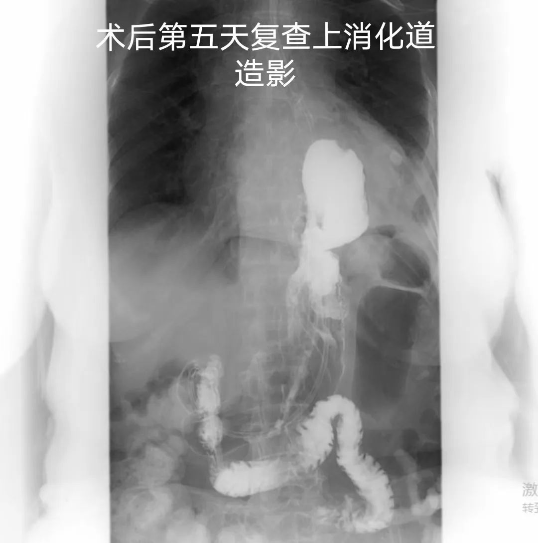 老人做贲门癌手术的几率是多少,80岁老人有必要做贲门癌手术吗