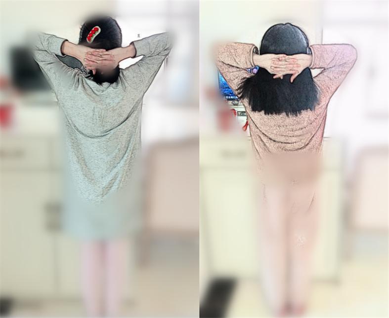 12岁女孩矫正脊柱侧弯,女孩侧弯矫正锻炼