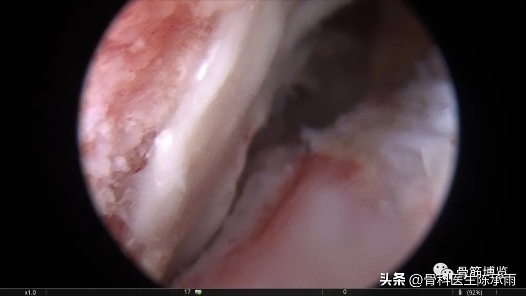 化脓性关节炎的穿刺引流治疗,关节炎镜下治疗