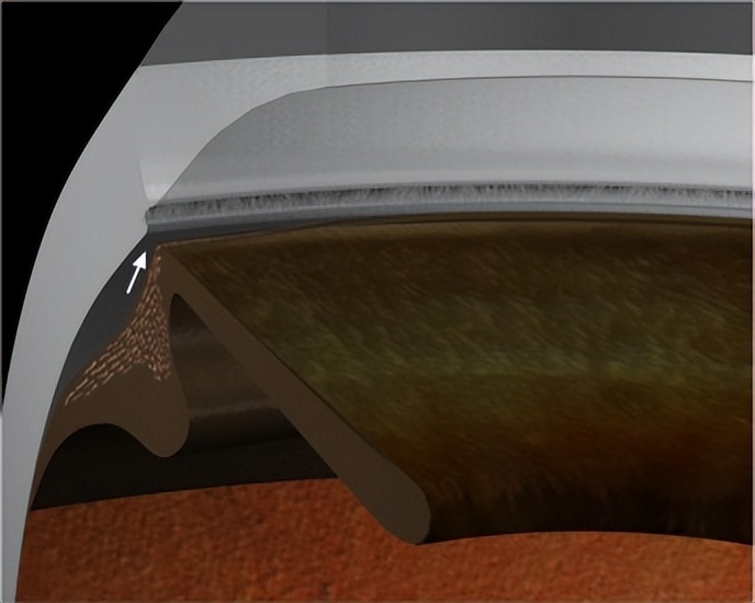 同济大学附属上海东方医院金海鹰教授：巩膜层间缝纫机技术要点