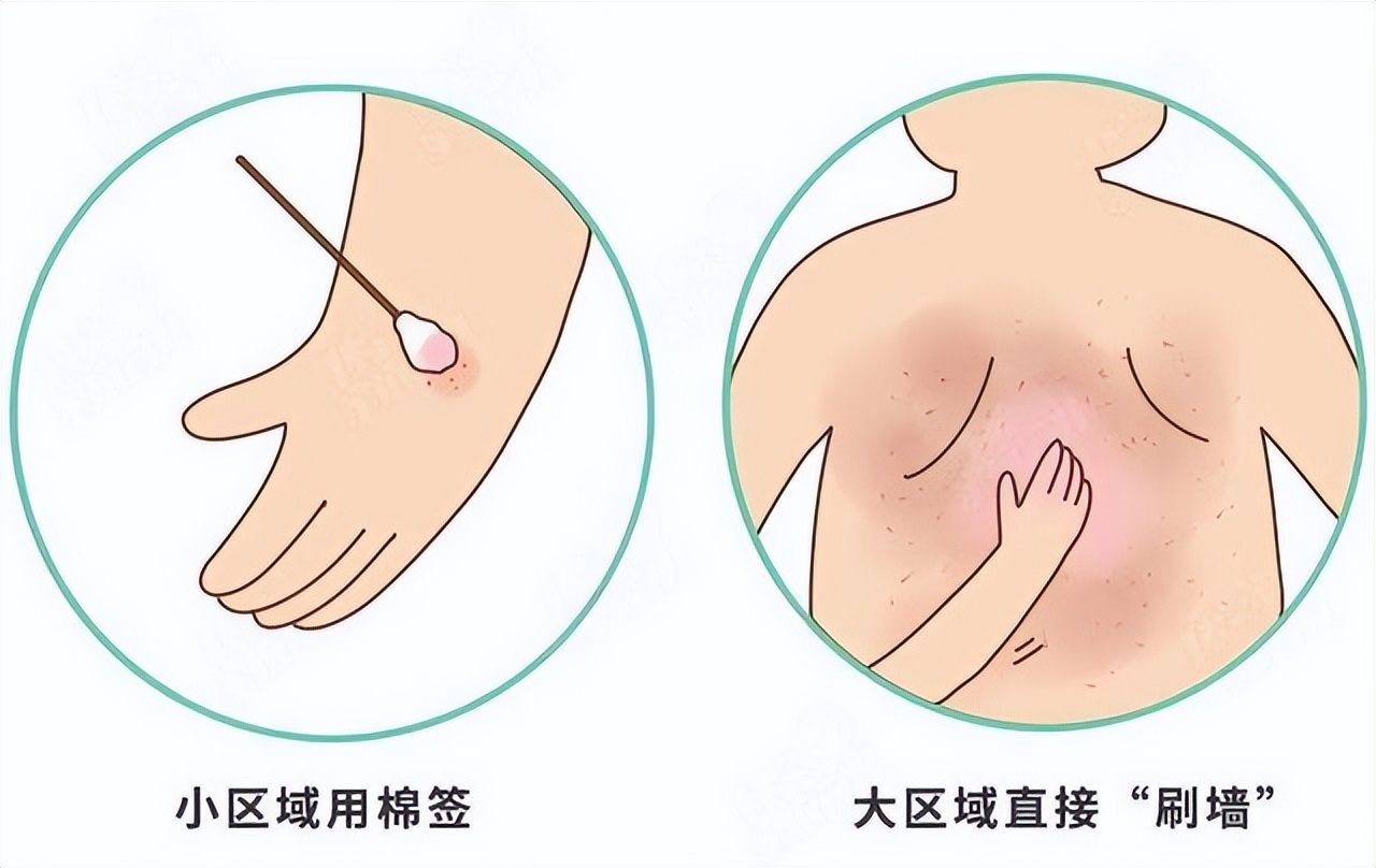 炉甘石洗剂现在要15元一瓶吗,炉甘石洗剂一瓶价格