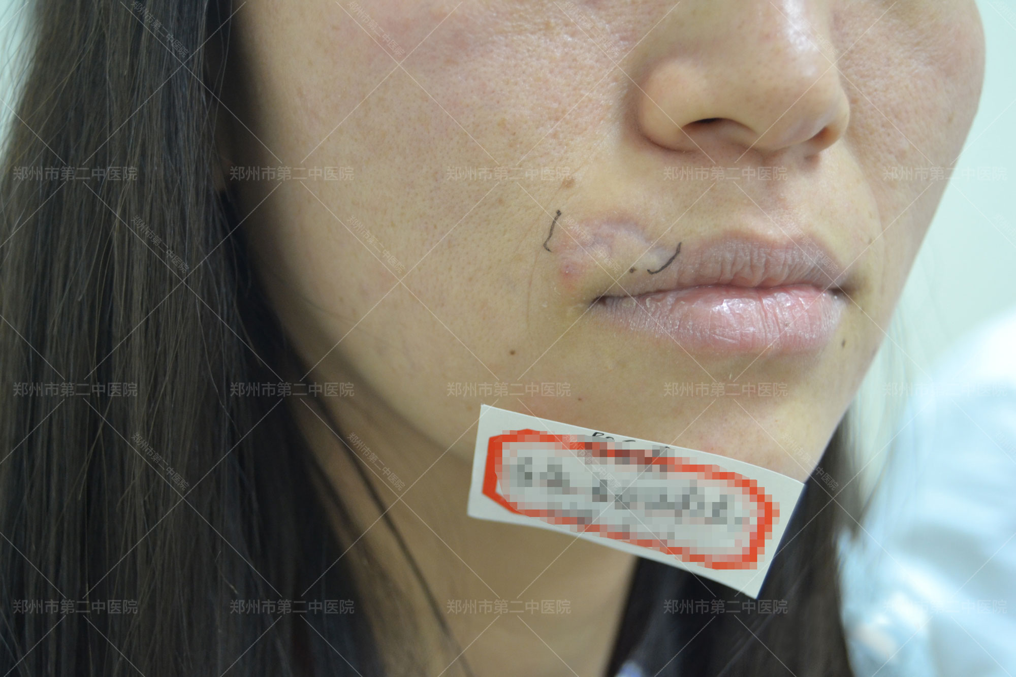 中国治疗凹陷疤痕最权威的医院,郑州第二中医院疤痕修复