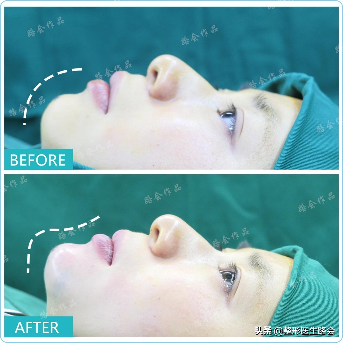 瞒着老爸，在北京隆下巴：22岁东*姑北**娘80天甩掉“肉乎乎包子脸”