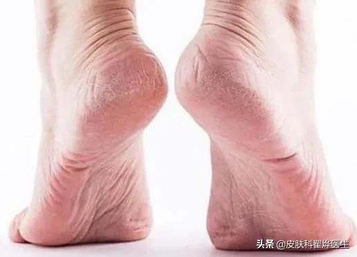 父母手皲裂用什么药,父母手脚皲裂