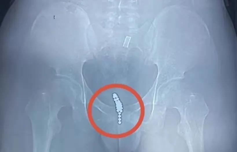 13岁男孩把1000颗磁力珠塞进管道,13岁男孩把68颗磁力珠塞进管道