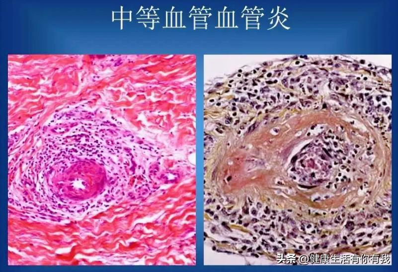 什么是血尿和尿潜血,什么是血尿是怎么回事