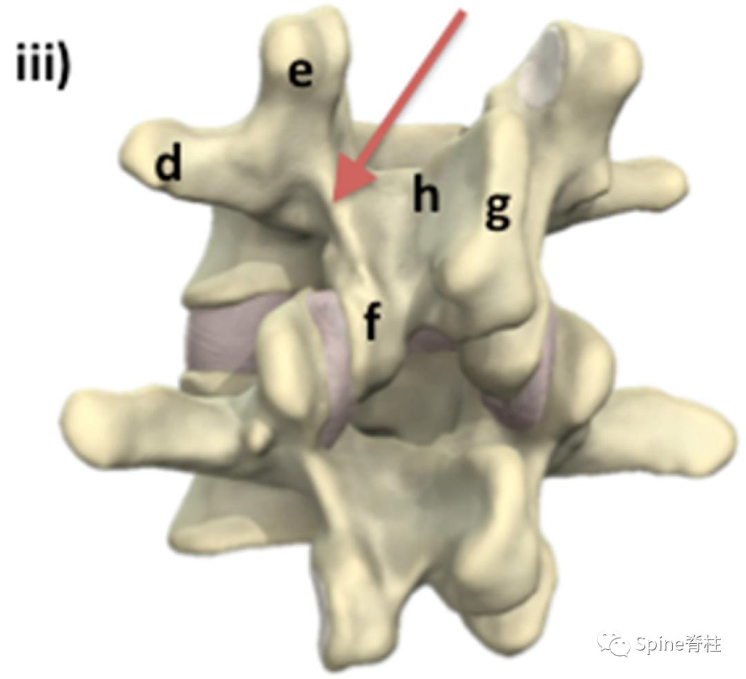 轻度峡部裂和重度峡部裂的区别,真性峡部裂和假性峡部裂